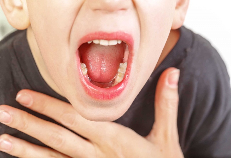 Viêm họng cấp tính