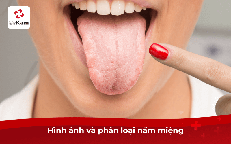 Hình ảnh và phân loại nấm miệng