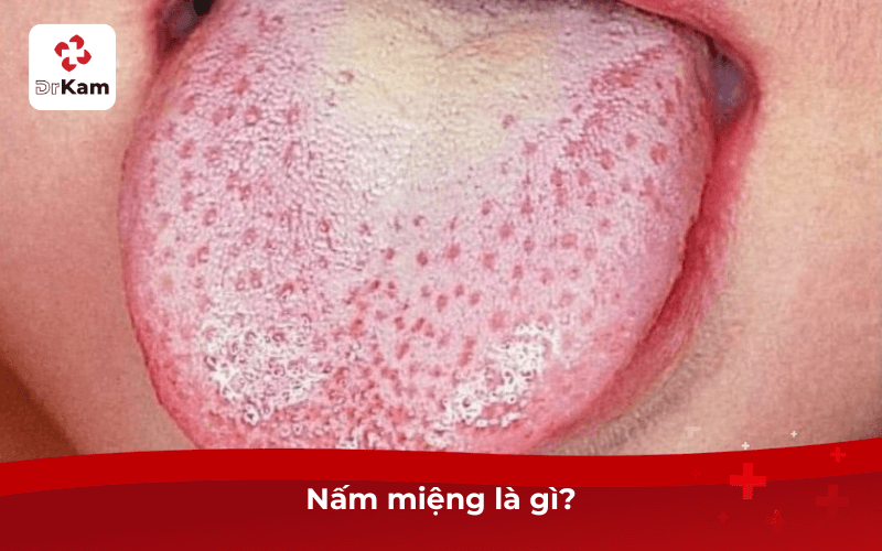Nấm miệng là gì?