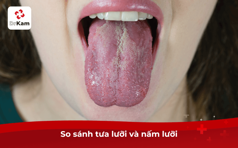 So sánh tưa lưỡi và nấm lưỡi
