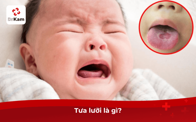 Tưa lưỡi là gì?