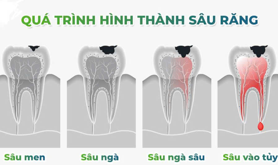 Các giai đoạn của sâu răng