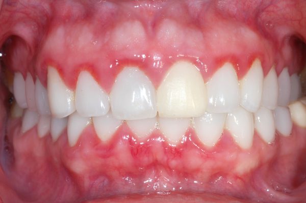 Hôi miệng: Nguyên nhân, đối tượng nguy cơ và cách phòng ngừa 10 Viêm nướu
