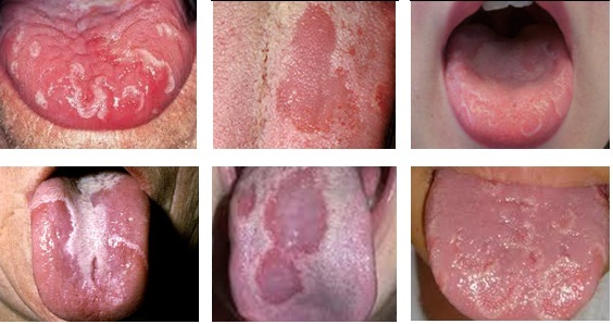 Triệu chứng của viêm lưỡi bản đồ