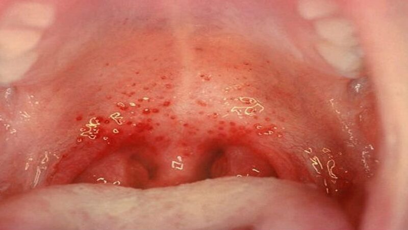 Viêm họng do liên cầu