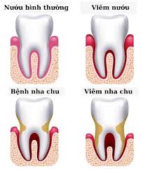 Hình ảnh mô tả sự khác biệt giữa nướu bình thường và viêm nha chu
