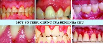 Một số triệu chứng của bệnh nha chu