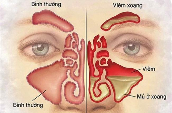 Viêm xoang