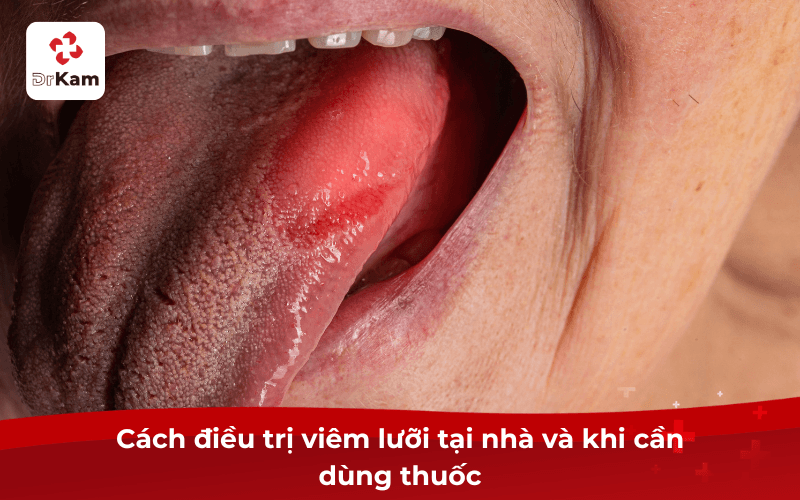 Cách điều trị viêm lưỡi tại nhà và khi cần dùng thuốc