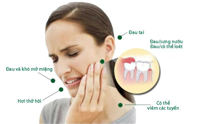 Mọc răng khôn: Dấu hiệu nhận biết là gì? 10 Biến chứng mọc răng khôn