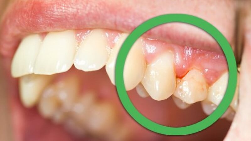 Viêm Quanh Cuống Răng: Nguyên Nhân, Triệu Chứng Và Cách Điều Trị Hiệu Quả 13 cr3