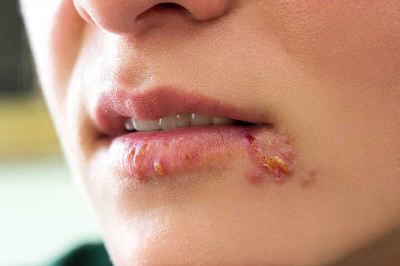 Hình ảnh lở miệng do nhiễm virus herpes