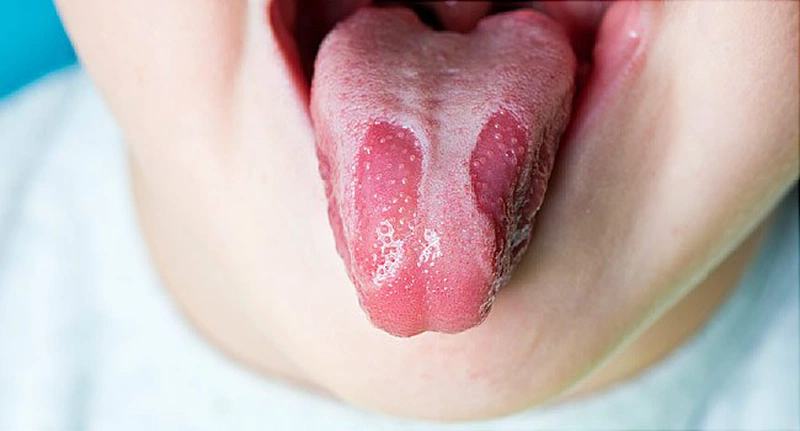Lưỡi Địa Lý: Nguyên Nhân, Triệu Chứng Và Cách Điều Trị 11 Hình ảnh lưỡi địa lý
