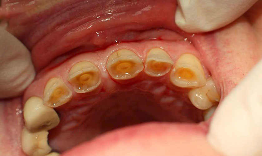 Hội Chứng Răng Bị Mòn Mặt Nhai: Triệu Chứng, Nguyên Nhân và Cách Điều Trị 11 Hình ảnh răng bị mòn mặt nhai