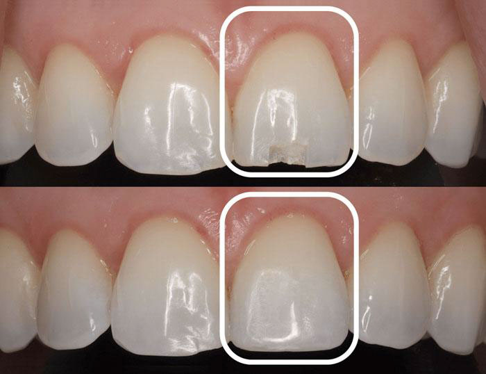 Hội Chứng Răng Bị Mòn Mặt Nhai: Triệu Chứng, Nguyên Nhân và Cách Điều Trị 13 Răng bị nứt nhẹ