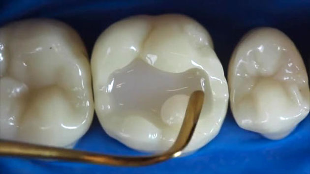 Hội Chứng Răng Bị Mòn Mặt Nhai: Triệu Chứng, Nguyên Nhân và Cách Điều Trị 14 Trám răng