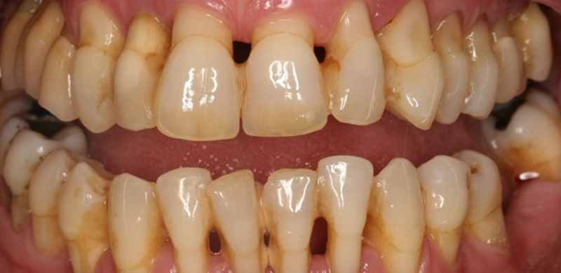 Bệnh Mô Nha Chu: Nguyên Nhân, Triệu Chứng Và Cách Điều Trị 10 Hình ảnh bệnh mô nha chu