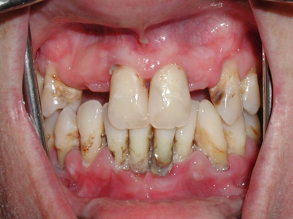 Bệnh Mô Nha Chu: Nguyên Nhân, Triệu Chứng Và Cách Điều Trị 12 mnc3