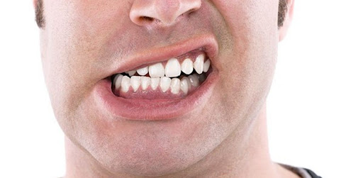 Hình ảnh tật nghiến răng