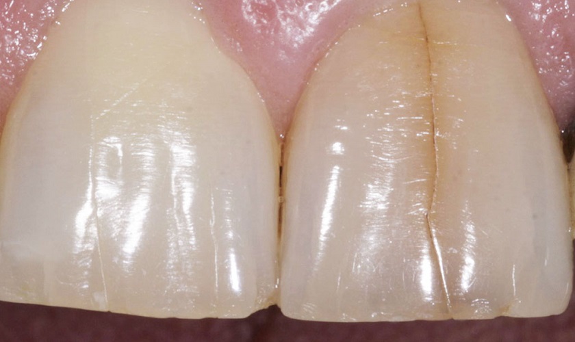 Răng cửa bị nứt đôi