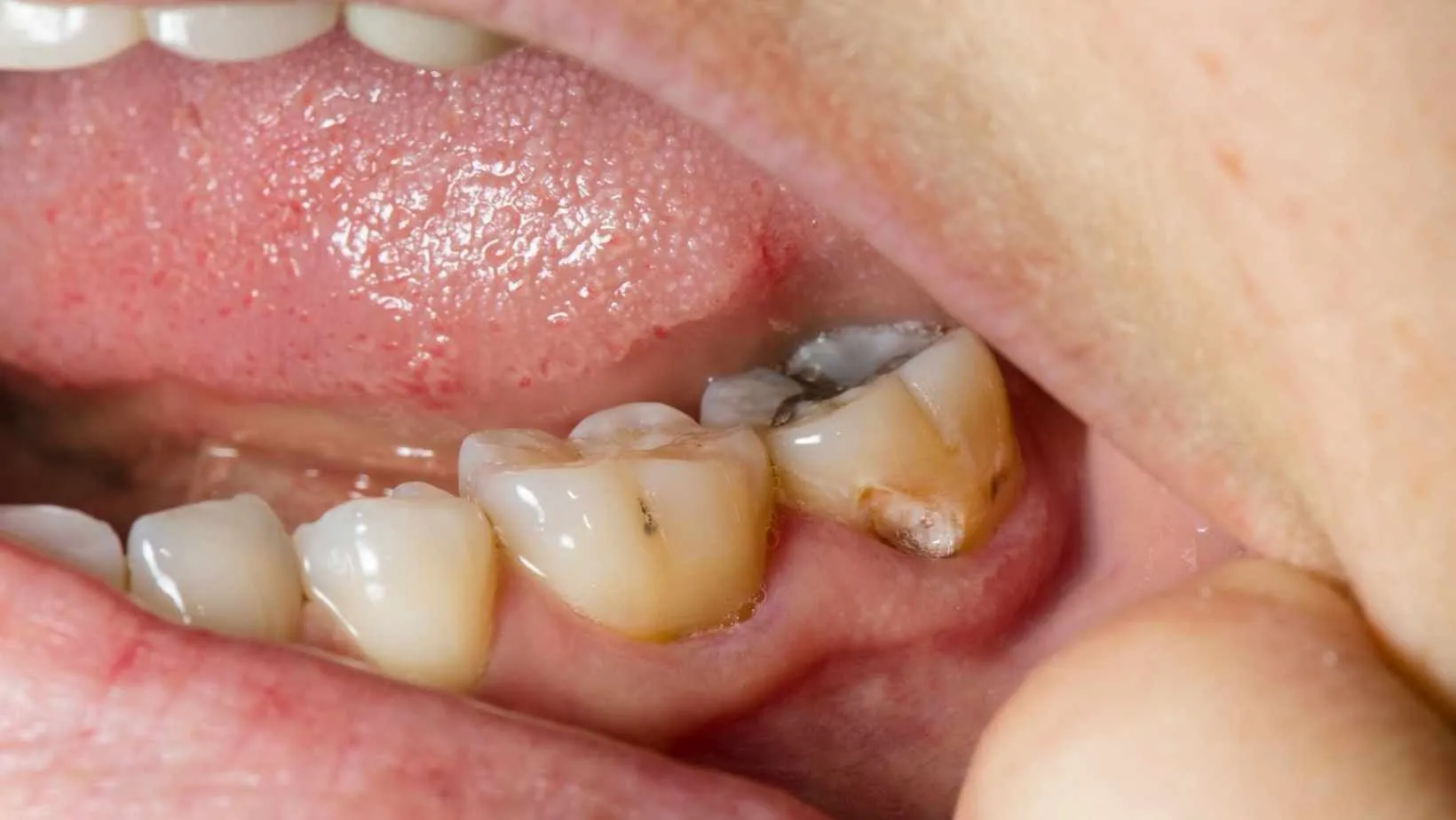Hình ảnh nhiễm trùng quanh răng khôn