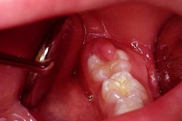 Lợi mọc trùm răng khôn