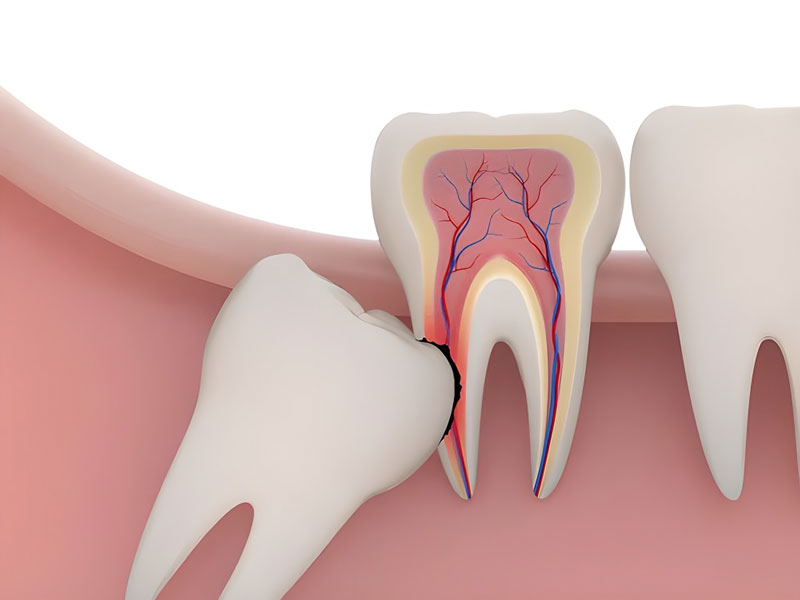 Răng khôn mọc lệch đâm vào răng số 7