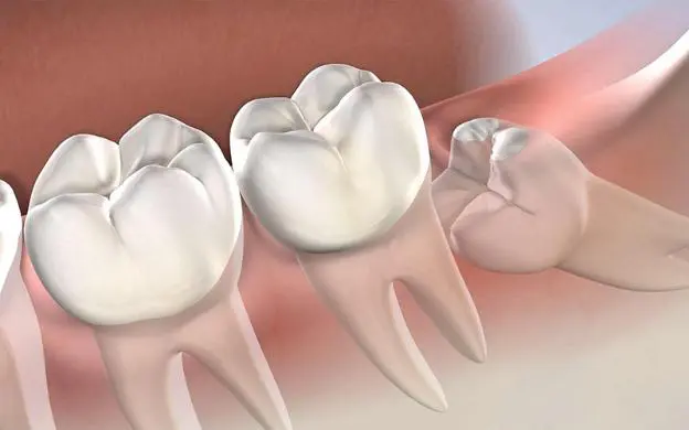 Mọc răng khôn: Dấu hiệu nhận biết là gì? 8 Răng khôn mọc xiên