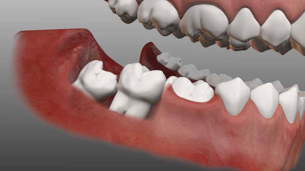 Răng số 8 mọc lệch đâm vào răng số 7