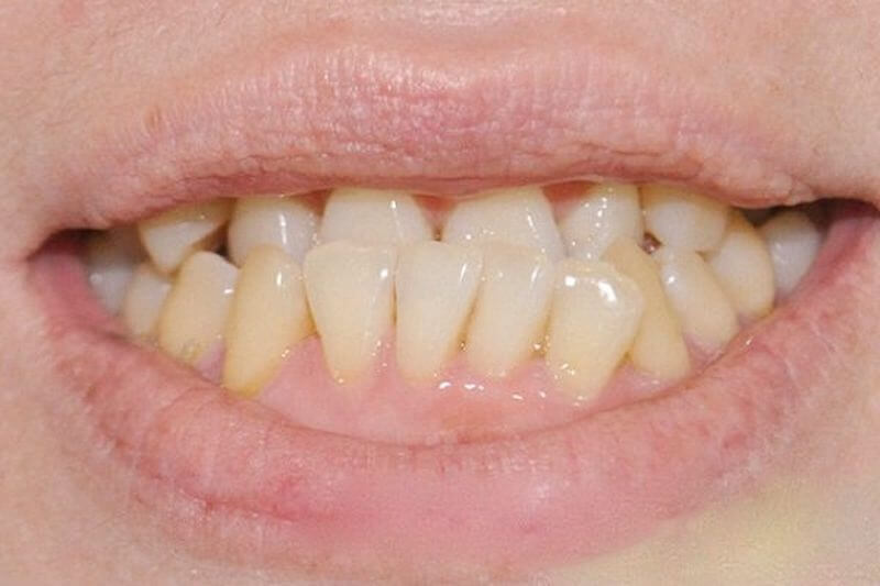 Hình ảnh răng mọc lệch