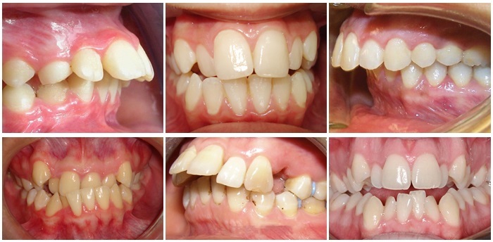 Khớp cắn lệch