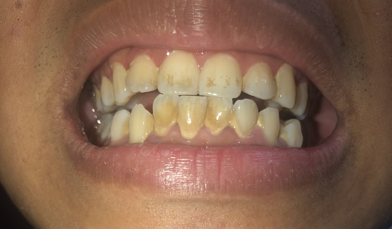 Răng Bị Đổi Màu: Nguyên Nhân, Triệu Chứng và Phương Pháp Điều Trị 11 Hình ảnh răng bị đổi màu