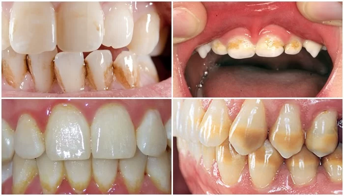 Răng Bị Đổi Màu: Nguyên Nhân, Triệu Chứng và Phương Pháp Điều Trị 13 rov3