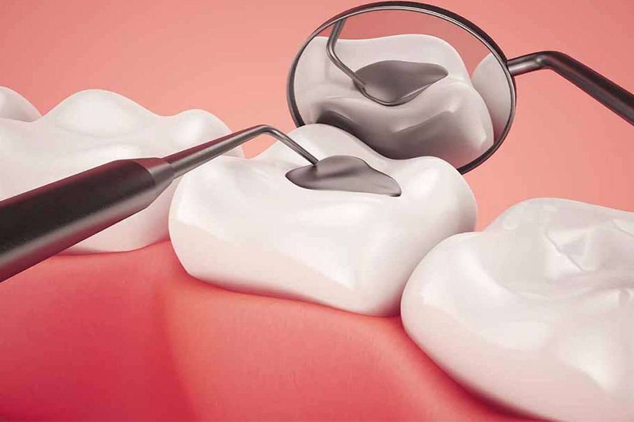 Trám răng để điều trị răng bị trấn thương
