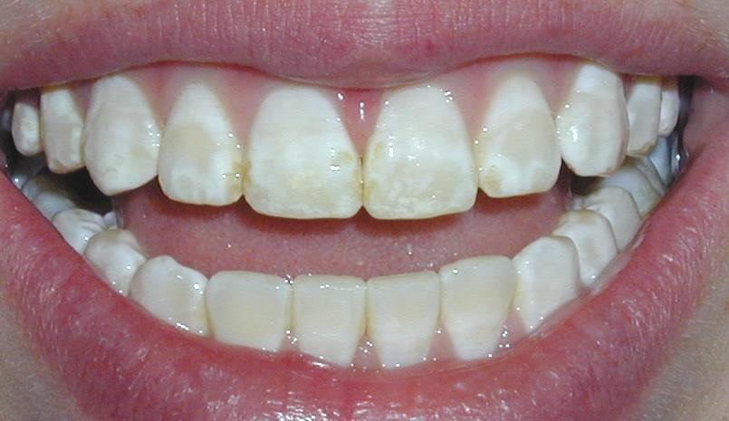 Hình ảnh thiểu sản men răng