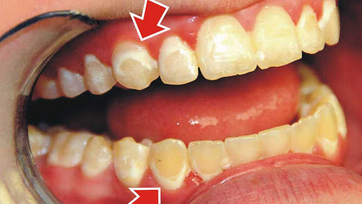 Các vết trắng đục trên răng