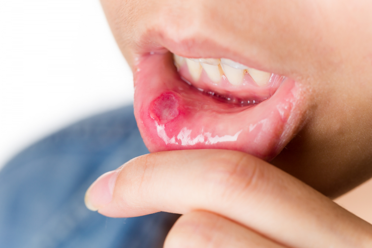 Viêm Miệng Áp Tơ (Aphthous Stomatitis): Nguyên Nhân, Triệu Chứng Và Cách Điều Trị Hiệu Quả 10 Hình ảnh viêm miệng áp tơ hay còn gọi là nhiệt miệng