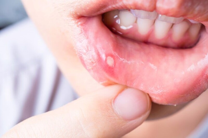 Viêm Miệng Áp Tơ (Aphthous Stomatitis): Nguyên Nhân, Triệu Chứng Và Cách Điều Trị Hiệu Quả 12 vat3