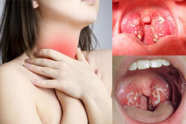 Đau họng khi viêm amidan
