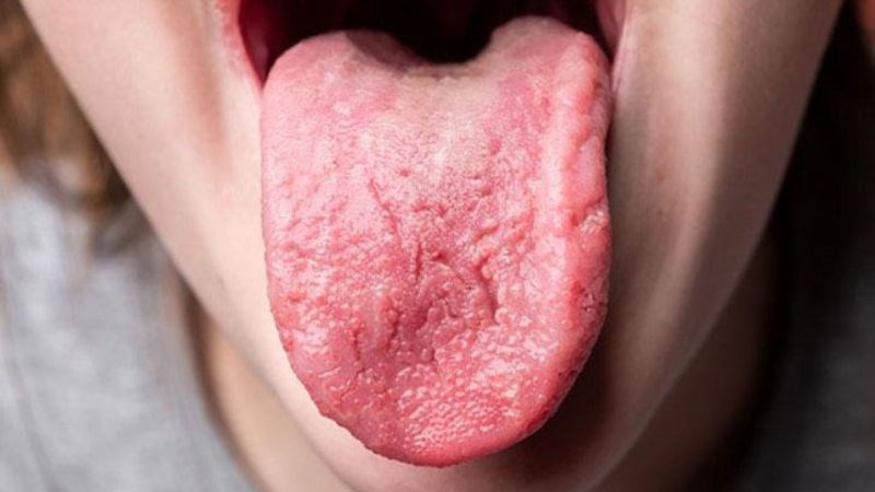 Hình ảnh viêm lưỡi