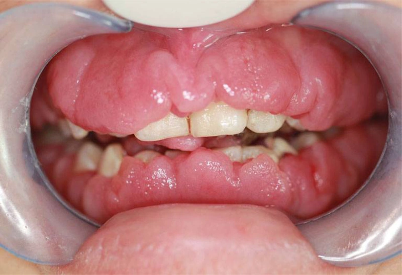 Hình ảnh viêm lợi phì đại