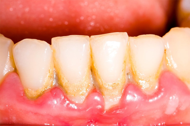 Mảng bám gây nên viêm lợi phì đại
