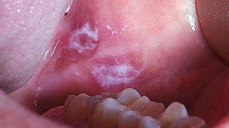 Bệnh Viêm Màng Nhầy Miệng: Nguyên Nhân, Triệu Chứng Và Phương Pháp Điều Trị 13 vmn3