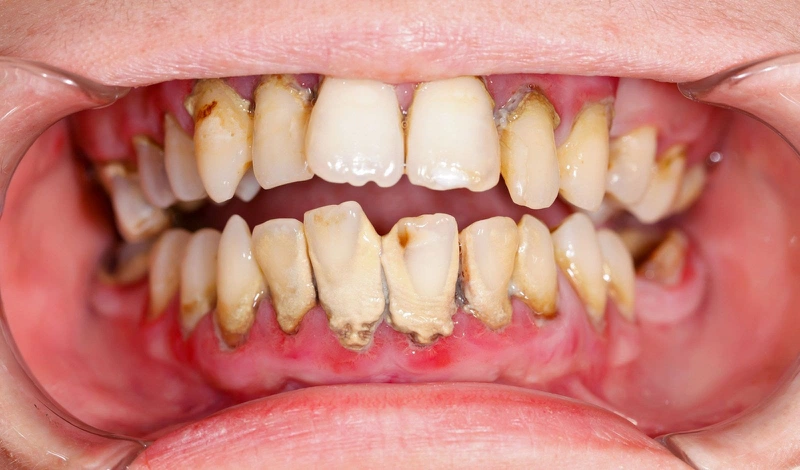 Viêm Nha Chu Mạn Tính: Tổng Quan, Cơ Chế Bệnh Sinh, Phương Pháp Chẩn Đoán Và Điều Trị 10 Hình ảnh viêm nha chu mạn tính