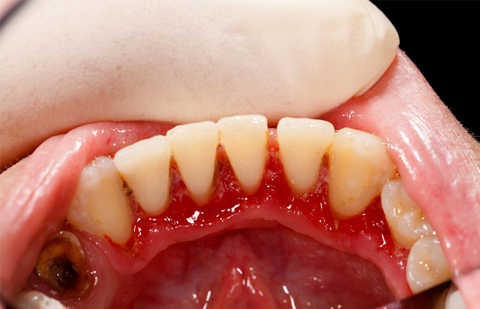 Viêm Nha Chu Mạn Tính: Tổng Quan, Cơ Chế Bệnh Sinh, Phương Pháp Chẩn Đoán Và Điều Trị 12 vncmt3