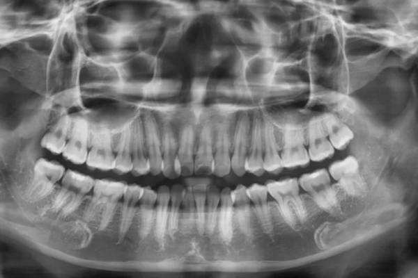 Viêm Quanh Chóp Răng: Nguyên Nhân, Triệu Chứng, Và Phương Pháp Điều Trị 13 Chụp X-quang để chẩn đoán bệnh