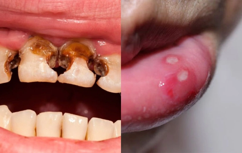 Bệnh Do Thiếu Hụt Vitamin: Nguyên Nhân, Triệu Chứng Và Cách Điều Trị 11 Thiếu hụt vitamin gây ảnh hưởng đến sức khỏe răng miệng