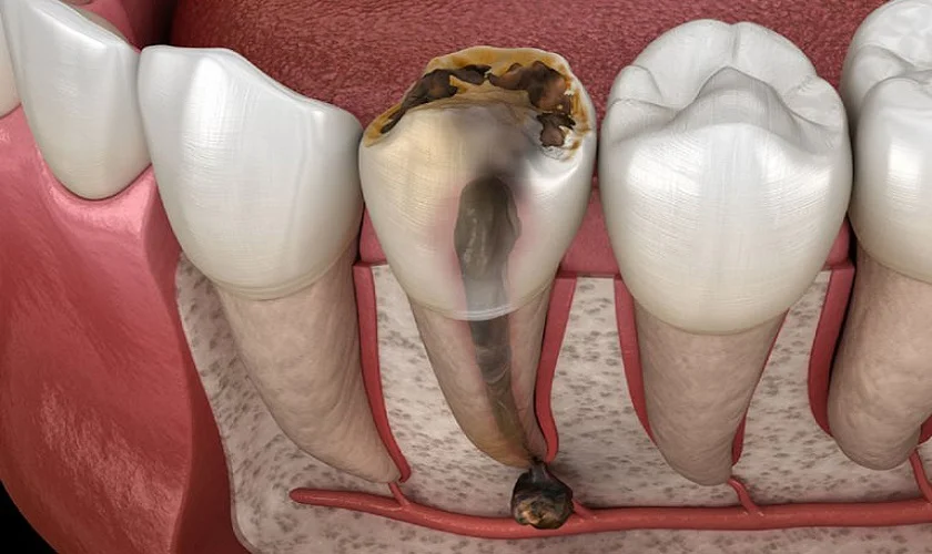Viêm tủy răng