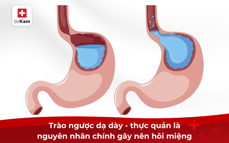 Tìm hiểu nguyên nhân và cách trị hôi miệng từ dạ dày hiệu quả 6 Trào ngược dạ dày - thực quản là nguyên nhân chính gây nên hôi miệng