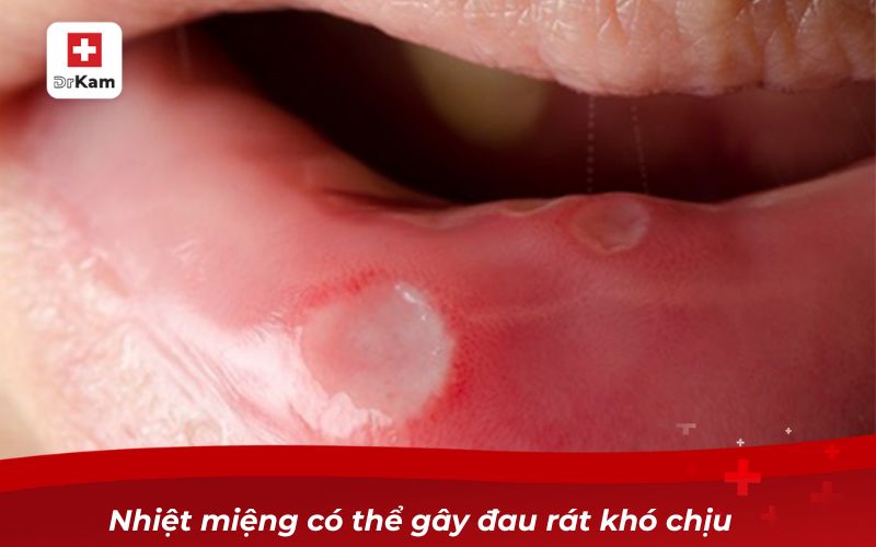 Người bị nhiệt miệng có nên súc miệng nước muối?